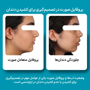 مقایسه پروفایل صورت در ارتودنسی با کشیدن و بدون کشیدن دندان مقایسه پروفایل متعادل صورت با جلوزدگی دندانها؛ یکی از عوامل مهم در تصمیمگیری برای ارتودنسی با کشیدن یا بدون کشیدن دندان