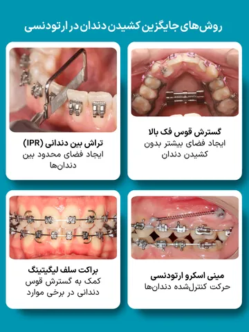 روش های جایگزین کشیدن دندان در ارتودنسی | اکسپنشن، IPR، مینی اسکرو و سلف لیگیتینگ تصویر روش های جایگزین کشیدن دندان در ارتودنسی شامل گسترش قوس فک (Expansion)، تراش بین دندانی (IPR)، مینی اسکرو ارتودنسی و براکت سلف لیگیتینگ برای ایجاد فضای درمان در برخی بیماران