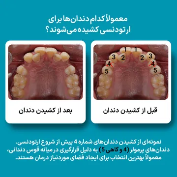 معمولاً کدام دندانها برای ارتودنسی کشیده میشوند؟ دندانهای شماره ۴ و ۵ نمونه کشیدن دندانهای پرمولر شماره ۴ پیش از ارتودنسی؛ دندانهایی که معمولاً برای ایجاد فضای درمان انتخاب میشوند