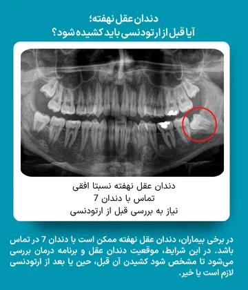 رادیوگرافی OPG دندان عقل نهفته قبل از ارتودنسی رادیوگرافی OPG بیمار با دندان عقل نهفته افقی در تماس با دندان ۷ برای بررسی نیاز به کشیدن دندان قبل از ارتودنسی