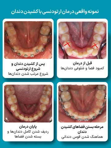 مراحل درمان ارتودنسی با کشیدن دندان؛ از قبل درمان تا پایان ارتودنسی مقایسه مراحل درمان ارتودنسی با کشیدن دندان شامل وضعیت قبل از درمان، شروع ارتودنسی، مرحله بستن فضاها و نتیجه نهایی درمان