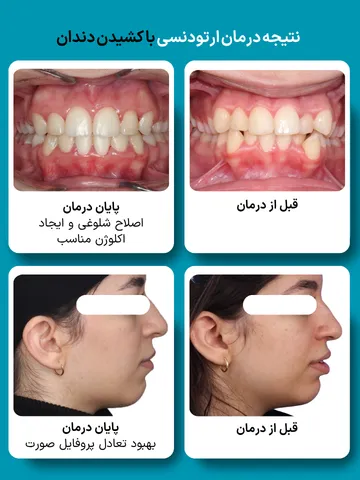 مقایسه قبل و بعد ارتودنسی با کشیدن دندان؛ اصلاح نظم دندانها و پروفایل صورت تصاویر قبل و بعد ارتودنسی با کشیدن دندان شامل نمای داخل دهان و نیمرخ صورت که بهبود نظم دندانها، اکلوژن و تعادل پروفایل را پس از درمان نشان میدهد
