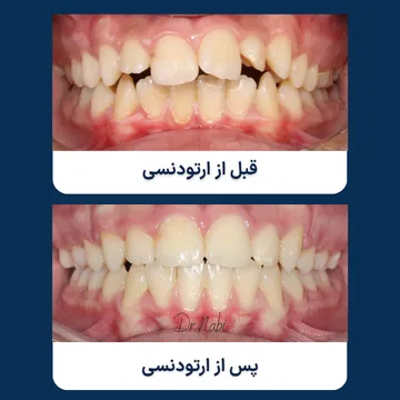 قبل و بعد درمان ارتودنسی برای اصلاح نامرتبی دندانها مقایسه نمای داخل دهانی بیمار قبل و بعد از درمان ارتودنسی برای اصلاح شلوغی و نامرتبی دندانها و بهبود نظم قوس دندانی.