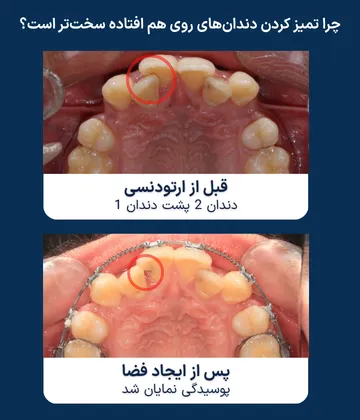 نمایان شدن پوسیدگی پنهان پس از ایجاد فضای ارتودنسی مقایسه قبل و بعد از ایجاد فضای ارتودنسی؛ در این بیمار، روی هم قرار گرفتن دندانها باعث دشوار شدن تمیز کردن ناحیه شده بود و پس از ایجاد فضا، پوسیدگی پنهان بین دندانها نمایان شد.