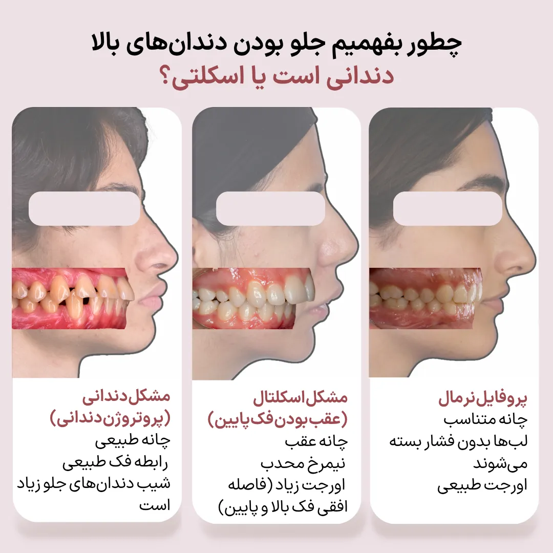 تشخیص جلو بودن دندانهای بالا؛ مشکل دندانی یا اسکلتی تشخیص علت جلو بودن دندانهای بالا با مقایسه پروتروژن دندانی، مشکل اسکلتی و پروفایل طبیعی