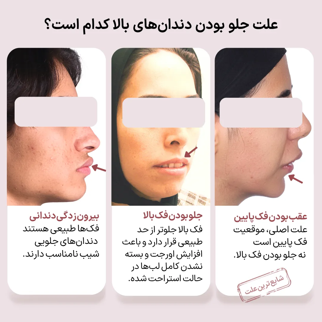 علتهای جلو بودن دندانهای بالا؛ مشکل دندانی یا فک؟ مقایسه علتهای جلو بودن دندانهای بالا شامل بیرونزدگی دندانی، جلو بودن فک بالا و عقب بودن فک پایین