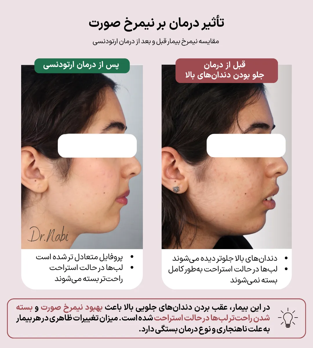 تغییر نیمرخ صورت قبل و بعد از درمان جلو بودن دندانهای بالا مقایسه نیمرخ بیمار قبل و بعد از درمان جلو بودن دندانهای بالا که بهبود وضعیت لبها و متعادلتر شدن پروفایل صورت را نشان میدهد.