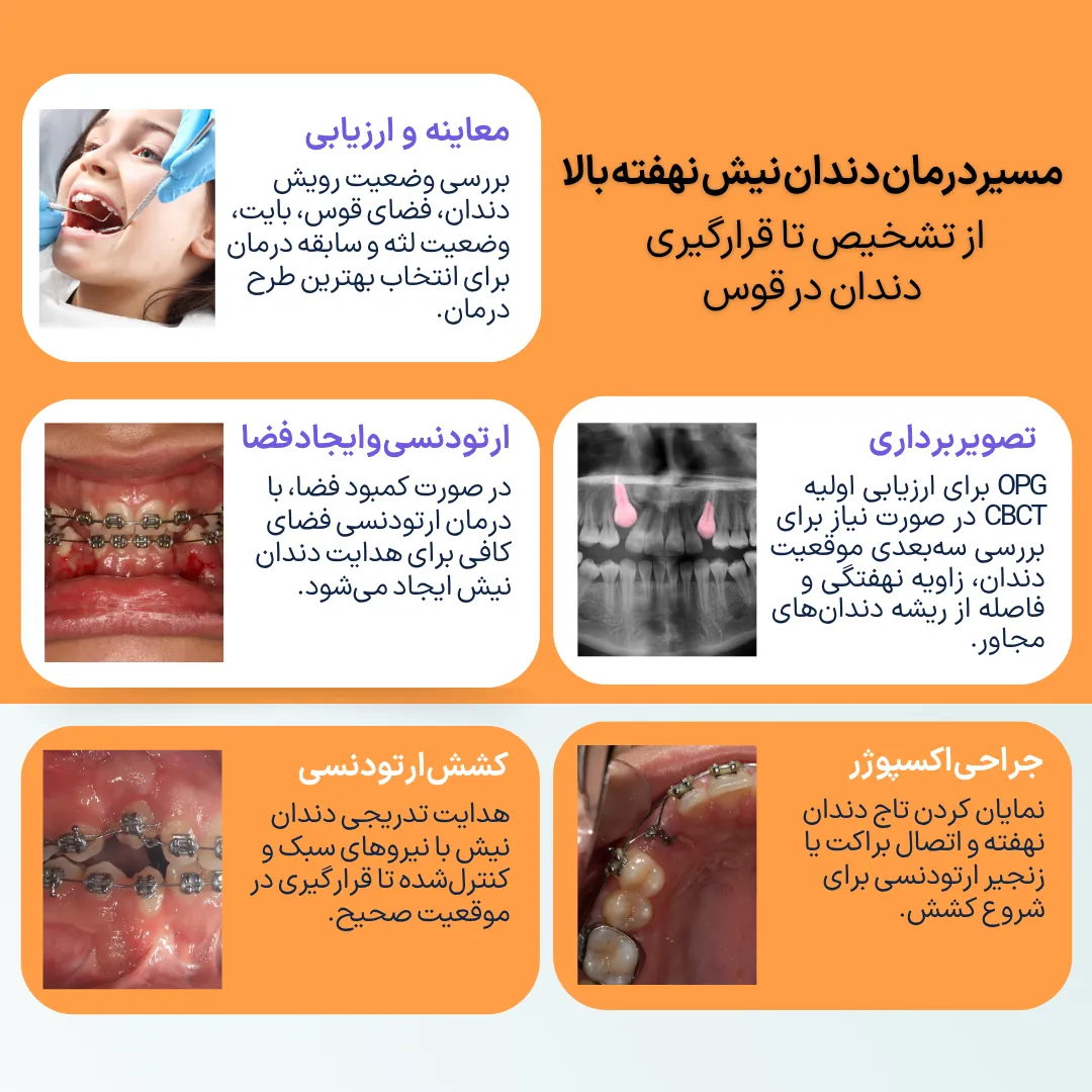 مراحل درمان دندان نیش نهفته بالا اینفوگرافیک مراحل درمان دندان نیش نهفته بالا شامل معاینه، تصویربرداری OPG یا CBCT، ایجاد فضا با ارتودنسی، جراحی اکسپوژر و کشش تدریجی دندان