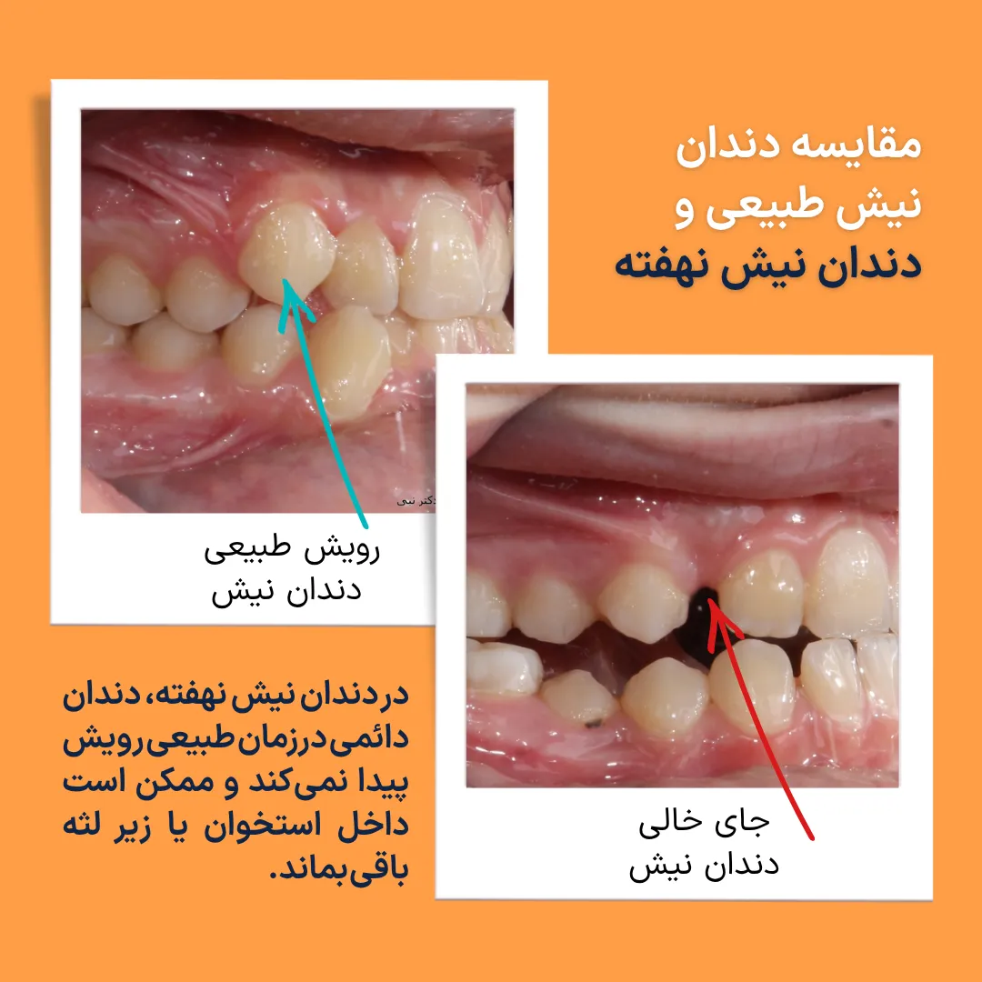 مقایسه دندان نیش طبیعی و دندان نیش نهفته بالا مقایسه نمای داخل دهان بیمار با دندان نیش طبیعی و بیمار دارای دندان نیش نهفته بالا که دندان نیش دائمی رویش نیافته است.