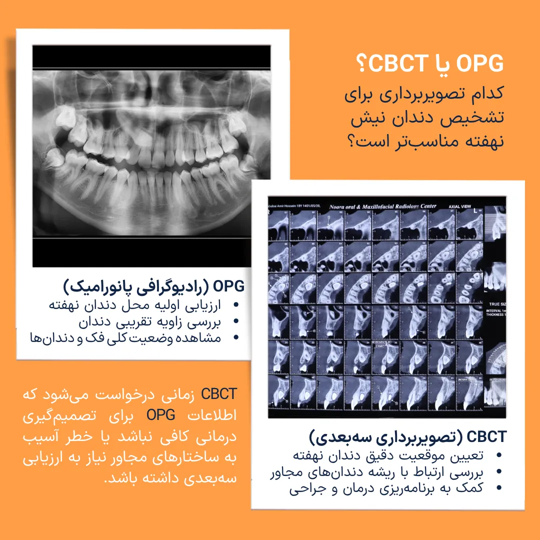 مقایسه OPG و CBCT در تشخیص دندان نیش نهفته بالا مقایسه رادیوگرافی پانورامیک OPG و تصویربرداری سهبعدی CBCT برای ارزیابی موقعیت دندان نیش نهفته بالا و بررسی ارتباط آن با ریشه دندانهای مجاور.