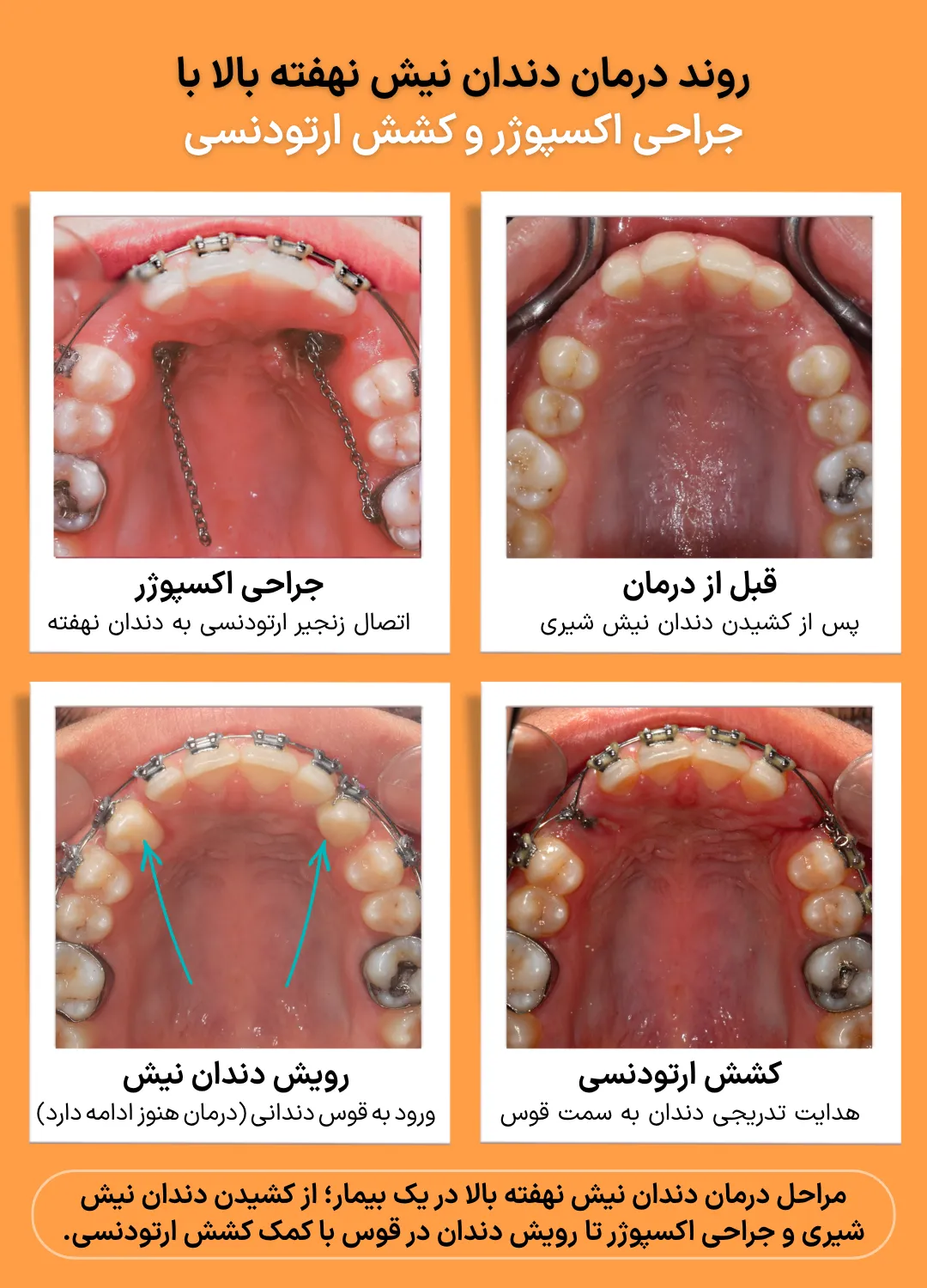 مراحل درمان دندان نیش نهفته بالا با جراحی اکسپوژر و کشش ارتودنسی تصاویر مرحلهبهمرحله درمان دندان نیش نهفته بالا شامل کشیدن دندان نیش شیری، جراحی اکسپوژر، کشش ارتودنسی و رویش دندان نیش در قوس دندانی.
