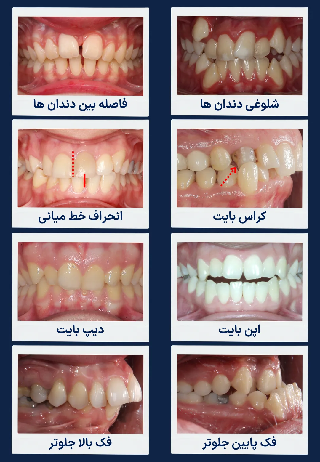 انواع مشکلات قابل درمان با ارتودنسی بزرگسالان اینفوگرافیک انواع ناهنجاری های قابل درمان با ارتودنسی بزرگسالان شامل شلوغی دندان ها، فاصله بین دندان ها، کراس بایت، دیپ بایت، اپن بایت، اوربایت، آندربایت و انحراف خط میانی