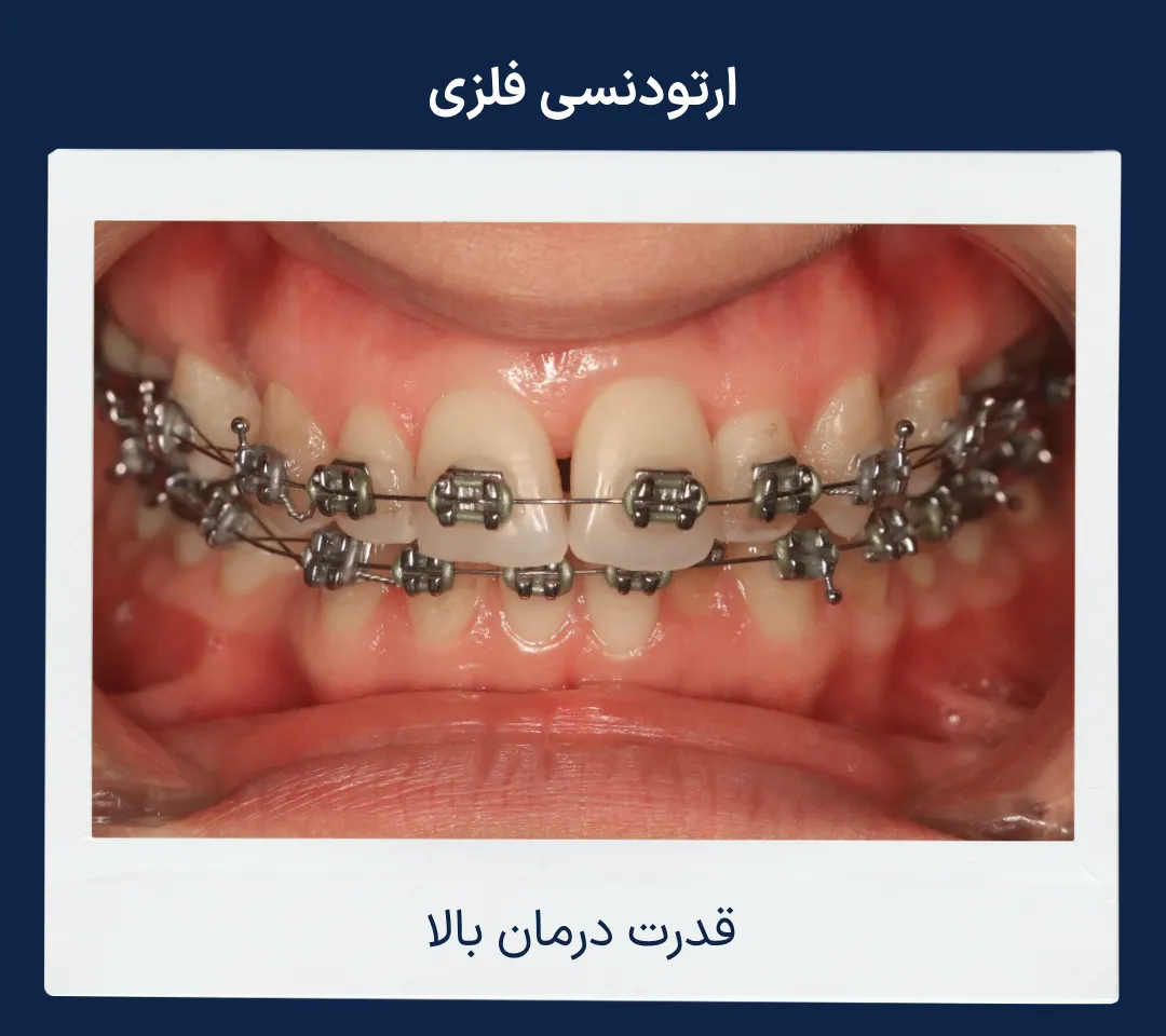 نمای نزدیک براکت فلزی ارتودنسی نمای نزدیک براکت فلزی مورد استفاده در درمان انواع ناهنجاری های دندانی