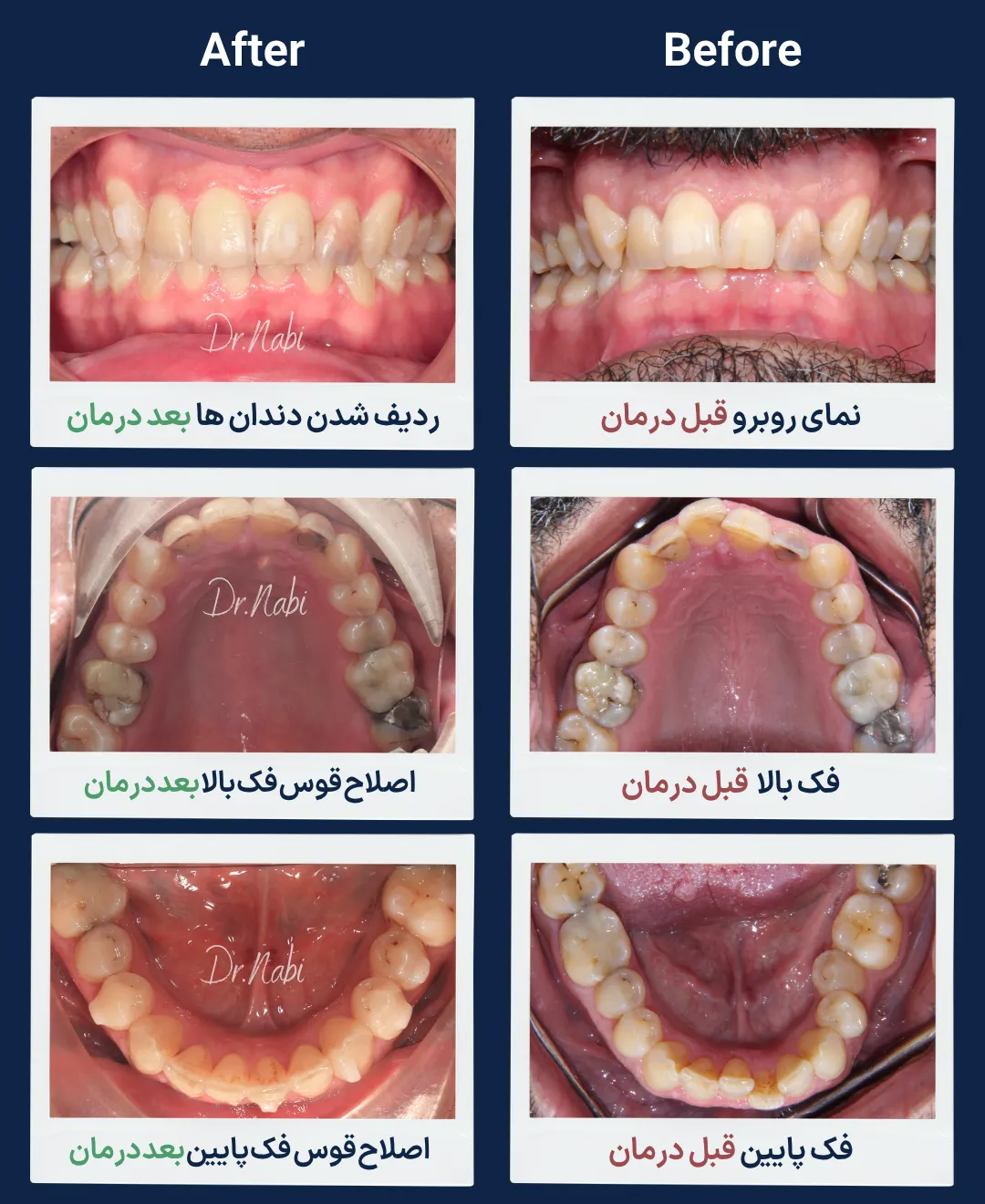 قبل و بعد ارتودنسی نامرئی آقای ۵۲ ساله با الاینر شفاف قبل و بعد درمان ارتودنسی نامرئی در بیمار ۵۲ ساله با الاینر شفاف، اصلاح نامرتبی و چرخش دندان ها و هماهنگ شدن قوس دندانی