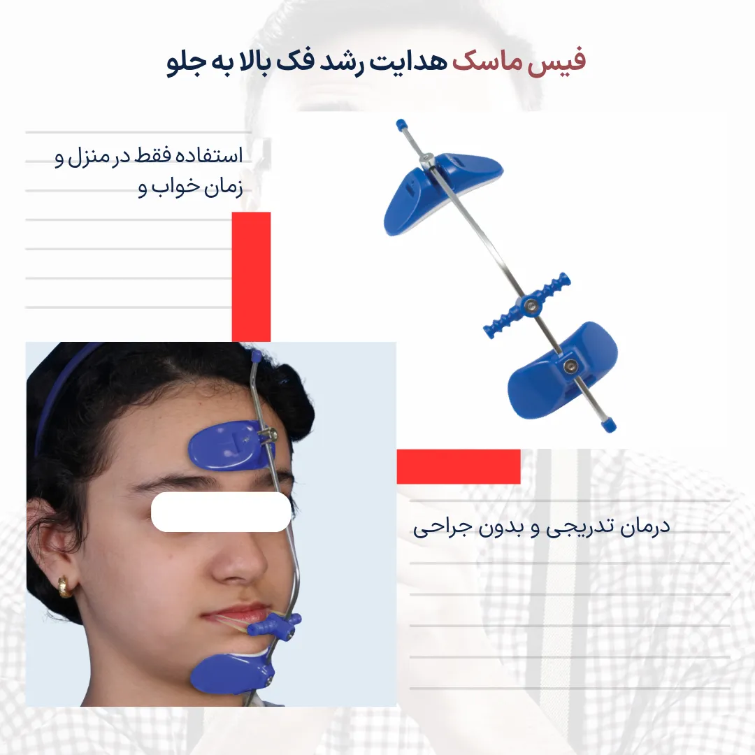 تصویر دستگاه فیس ماسک ارتودنسی برای اصلاح رشد فک بالا در کودکان که با اعمال نیروی کنترل شده به درمان جلو بودن فک پایین کمک کرده و معمولاً درد شدید ایجاد نمیکند.