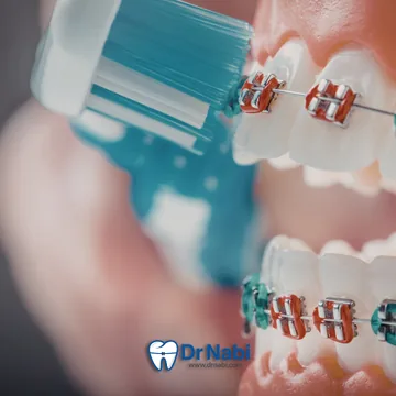 تمیز کردن سطح براکت با مسواک با مسواک ارتودنسی مستقیم روی سطح براکت ها تمیز میشه
