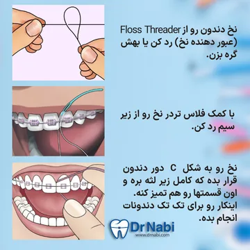 روش استفاده ازنخ دندان در ارتودنسی عبور دادن نخ با فلاس تردر از زیر سیم و تمیز کردن فضای بین دندان ها