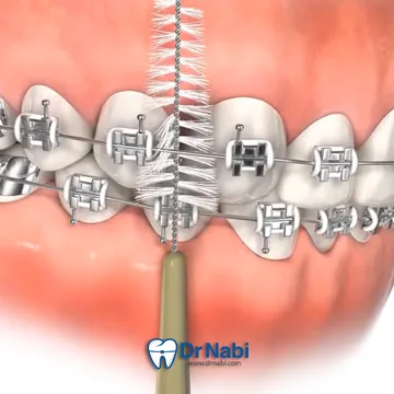 روش استفاده از فرچه بین دندانی وارد کردن مسواک بین دندانی بین براکت ها برای حذف پلاک و خرده غذا