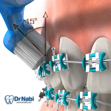 نحوه صحیح گرفتن مسواک با زاویه 45 درجه مسواک زدن دندان های دارای براکت با زاویه 45 درجه برای تمیز کردن لبه لثه و زیر سیم
