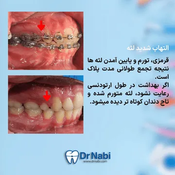 التهاب و تورم لثه در اثر بهداشت ضعیف لثه قرمز و متورم اطراف براکت به دلیل تجمع پلاک