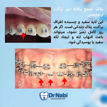 لایه سفید و چسبنده پلاک میکروبی روی دندان دارای ارتودنسی پلاک میکروبی تجمع یافته دور براکت ها و التهاب لثه ناشی از آن